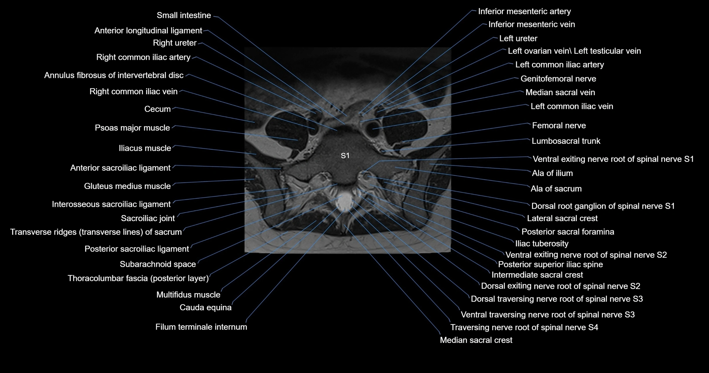 MRI lumbar spine axial cross sectional anatomy 3T radiology  image-img-00001-00045.webp